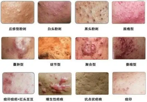 厨房一"宝"加常喝"白色液体"痘痘,粉刺,一周去无踪,肌肤光滑嫩白