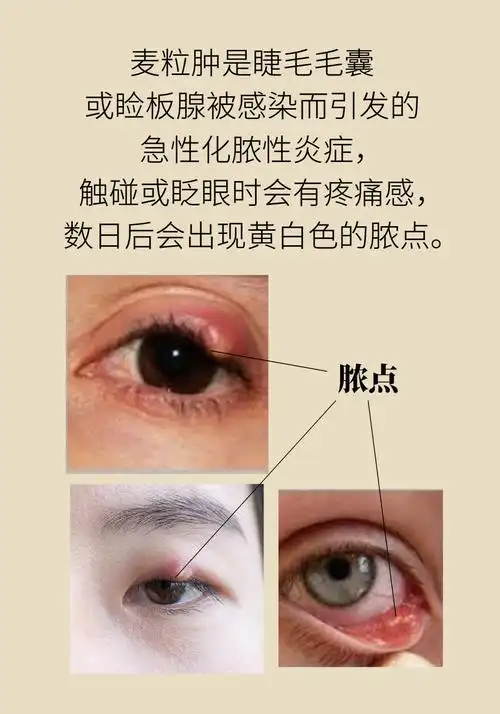 针眼一年复发五六次怎么办戴隐形眼镜和化妆须注意这些