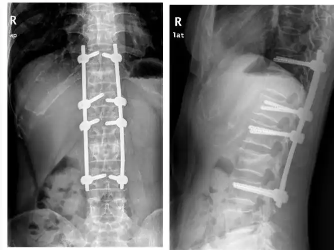 骨科二区开展首例椎体压缩性骨折经皮椎弓根钉内固定术