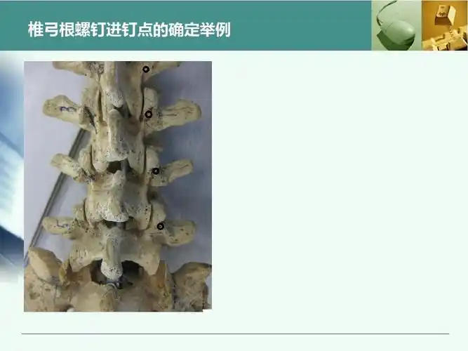 (共45页,当前第18页) 你可能喜欢 椎弓根钉 钉钉 椎弓根钉内固定术 的