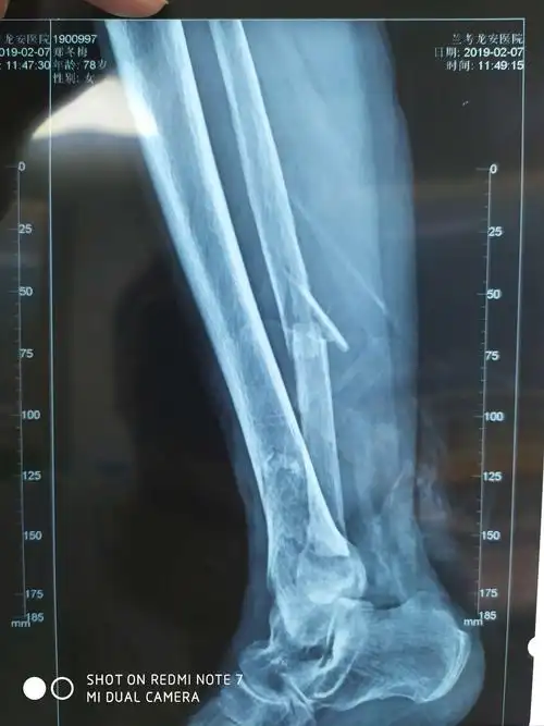 颠覆传统让小腿骨折立即下床负重行走 ——兰考县首例应力外架在中心