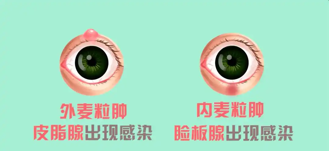 发现眼睑上的麦粒肿_炎症_治疗_化脓性