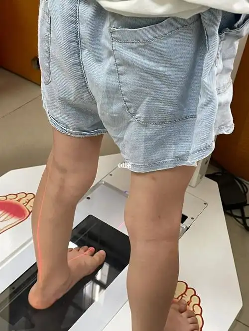 儿童足外翻 扁平足 xo型腿治疗.