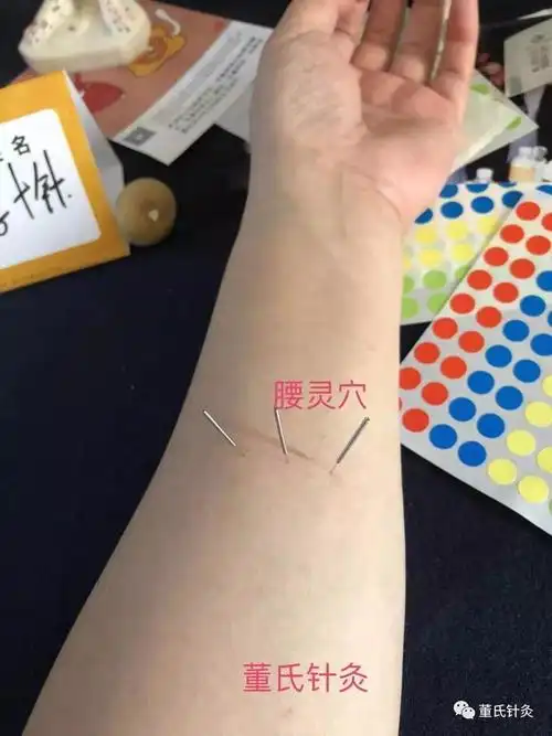 董氏针灸林正泰案例分享之腰灵穴