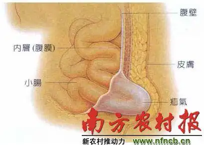 【南方农村报】七旬翁腹部术口鼓出大包块,四个大疝气一次手术除