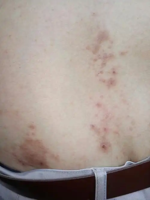 这是什么皮肤病?