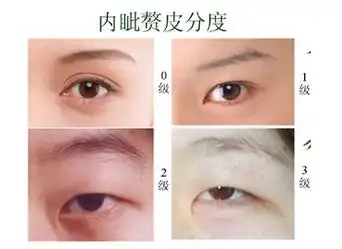 所以,当你的眼睛存在内眦赘皮的情况,医生肯定会为了让你的重睑