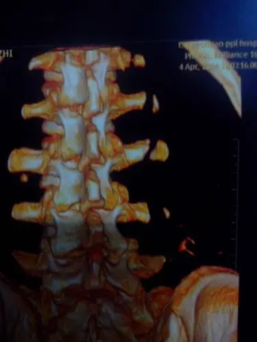 腰椎l1-l4横突骨折