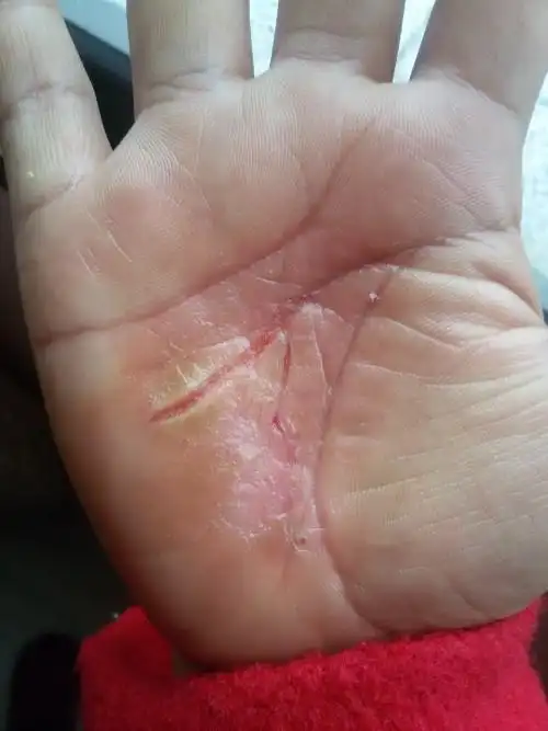 我手掌心奇痒开裂硬皮
