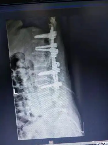 腰1椎体爆裂性骨折,腰1 2 3双侧横突骨折