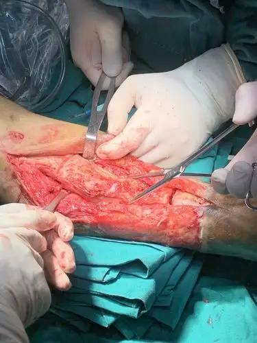 胫骨慢性骨髓炎,胫骨延长搬运术