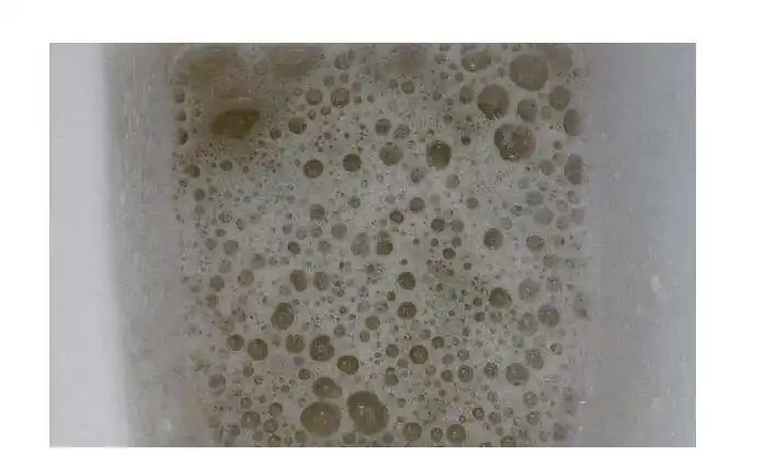 尿液里有很多泡沫是不是肾出了问题是这两种情况不用太担心