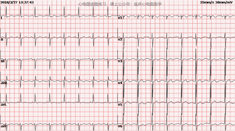 左心房异常(二尖瓣型p波),ptf-v1