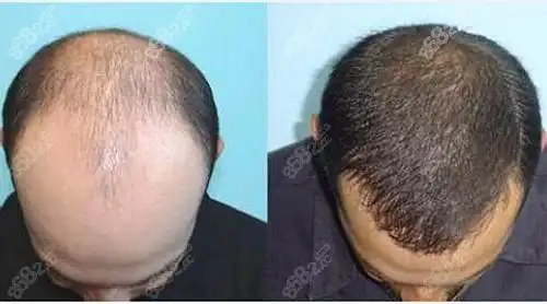 头顶植发效果对比图
