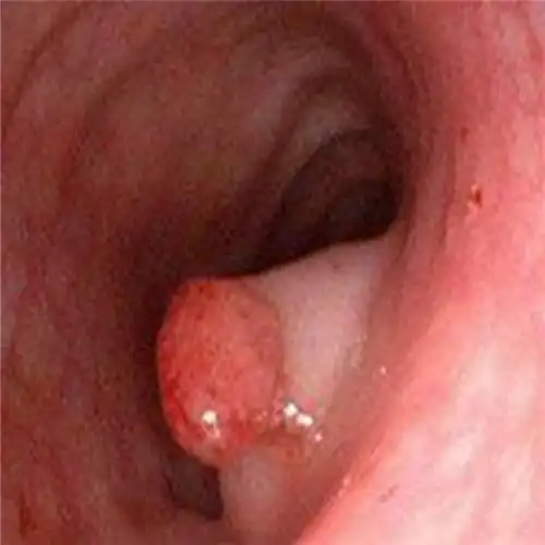 直肠息肉图片_直肠息肉症状表现图片大全_有来医生