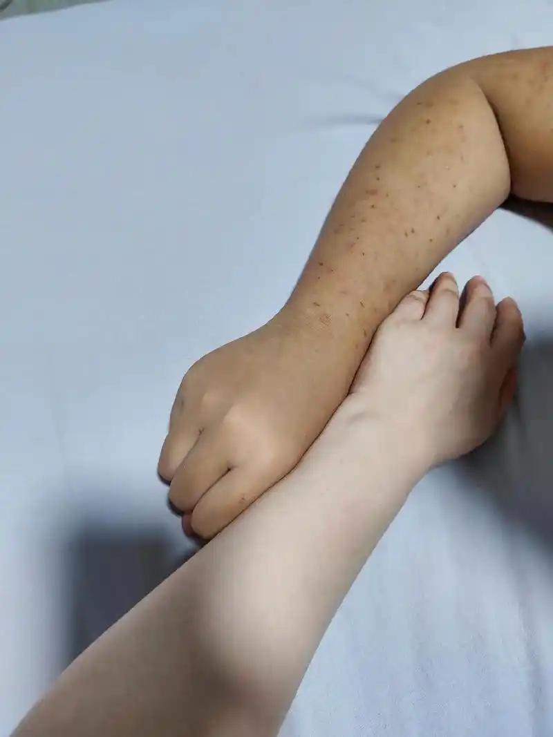 唉我引以为傲的好皮肤为啥没有遗传给你这又黑又烂的手臂啊惨不忍睹