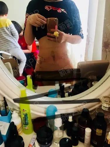 今天是杭州港丽腰腹吸脂第三天  不想多说什么,直接看照片吧