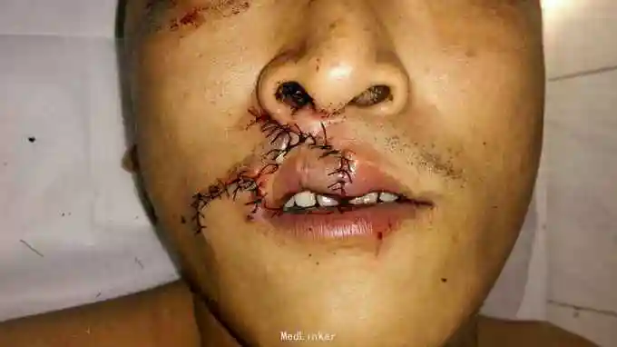 5cm诊断 处理诊断～上唇裂伤伴组织缺损 急诊手术,患者不愿住院治疗