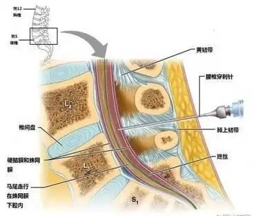 解密腰椎穿刺