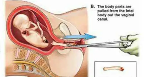 "查出是女儿又想打掉", 四个月大的胎儿是如何被引产