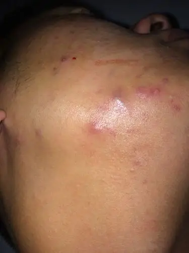 求助,请问这是座疮还是暗疮还是什么东西啊!