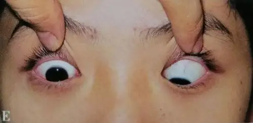 外伤后可出现眼球运动障碍,可由眼外肌移位牵拉或嵌顿而致.