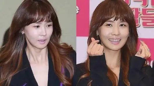 李多海过度整容脸僵笑不出看出道前后容貌变化