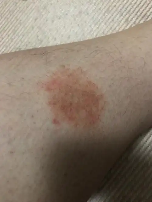 小腿上长了一块红斑,不痛不痒,之前是很小一块,慢慢扩散变大了-丛林主