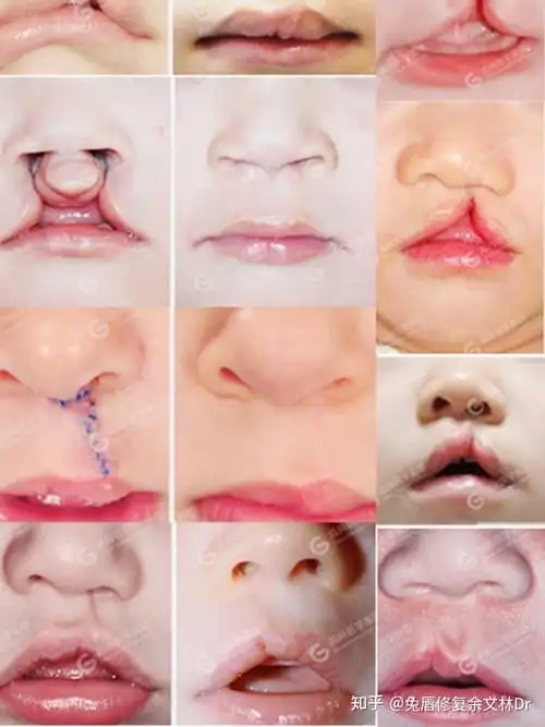 单侧唇裂的治疗时机一般在患儿年龄满3个月,双侧唇裂为患儿年龄满6个