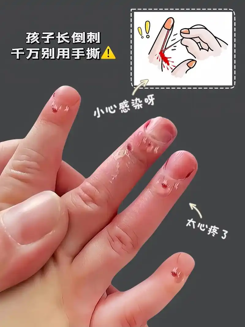 宝宝手指皮薄,起倒刺太疼太难受了!