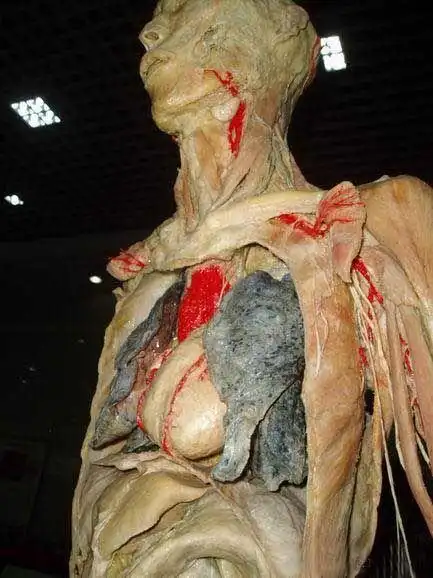 吸烟肺,肺癌图片!