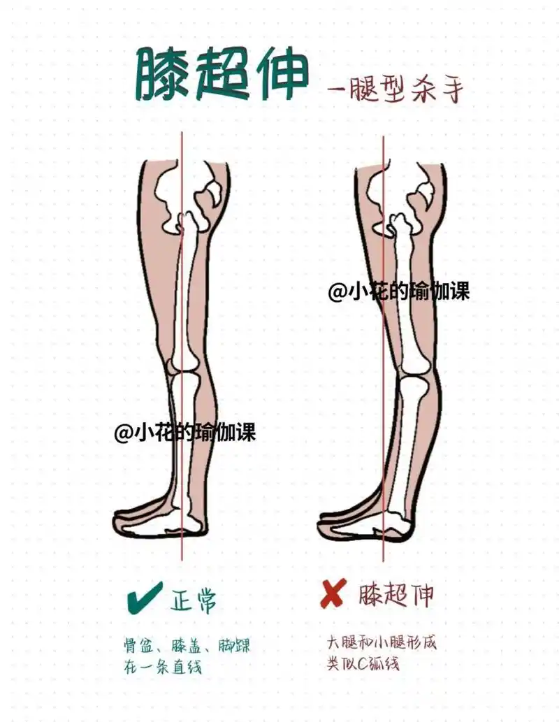 94干货 |终于有人把膝超伸讲明白了调整思路 [赞同]相信很多宝子都