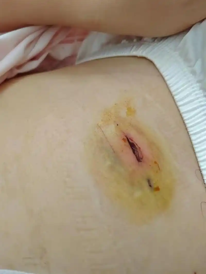 换药看到自己的伤口,这样的伤口96四个,有人说腹腔镜是小手术,睡