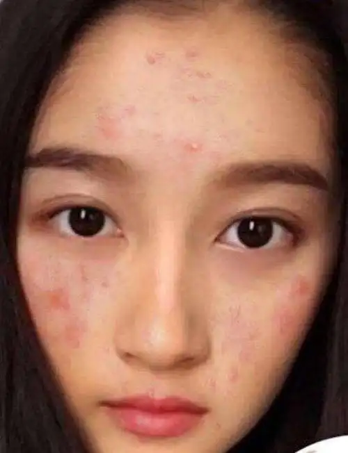 杨幂赵丽颖满脸痘痘,迪巴关晓彤有红斑,微商炒作这样做好吗?