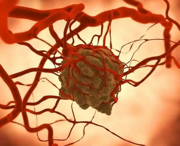 良性与恶性肿瘤图片