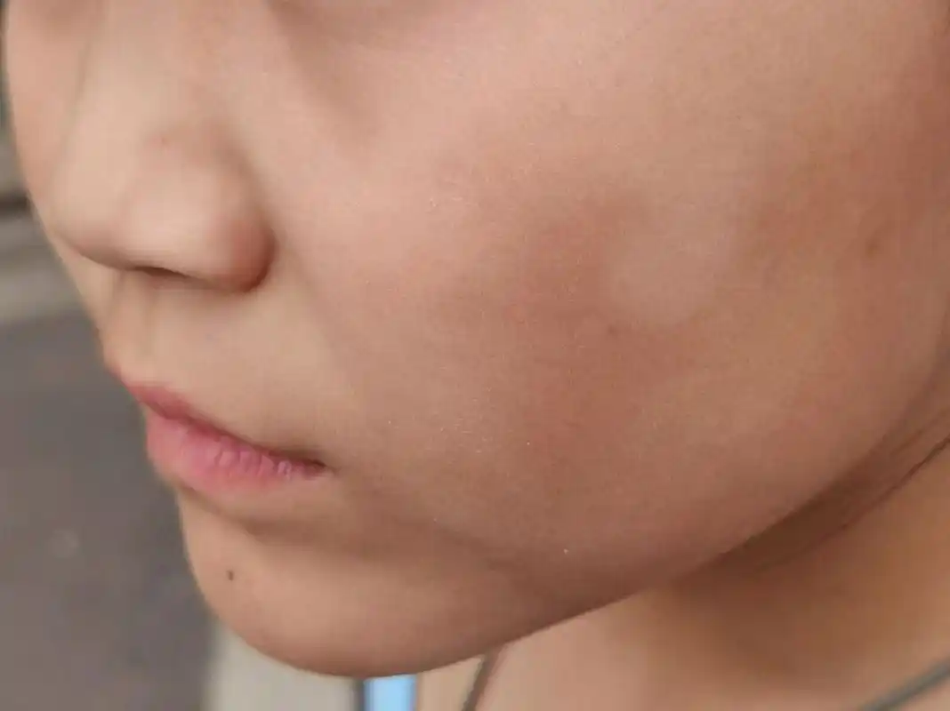 白色糠疹 小朋友肤色较黑,但一到春夏,脸上有出现一小块白斑,不痛不痒