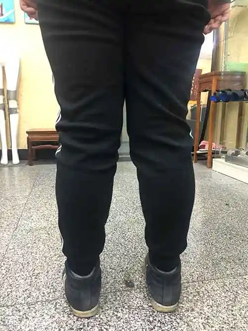 中老年男性x型腿矫正案例