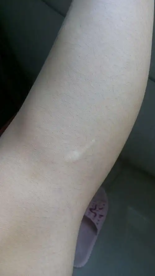 腿上有个小时候淘气留下的疤痕夏天穿短裙子短裤露出来大家会嘲笑我么