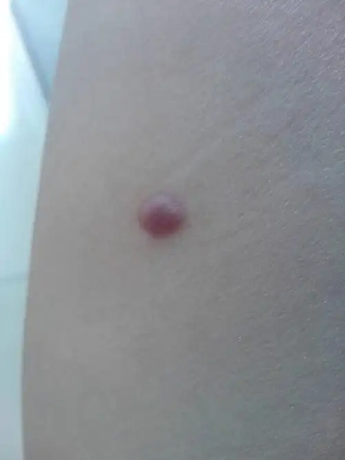 大腿大长了一个这样的东西怎么办?偶尔还会痒