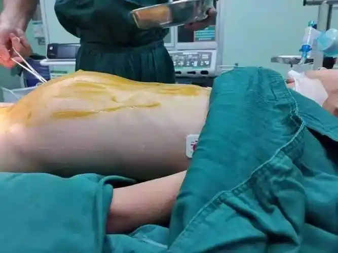 女孩腹部隐藏巨大肿瘤,山一大二附院小儿外科成功切除_手术