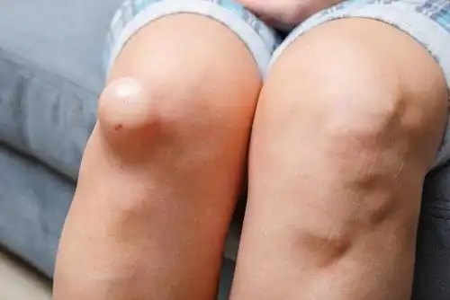 膝关节滑膜炎的危害有什么膝盖滑膜炎