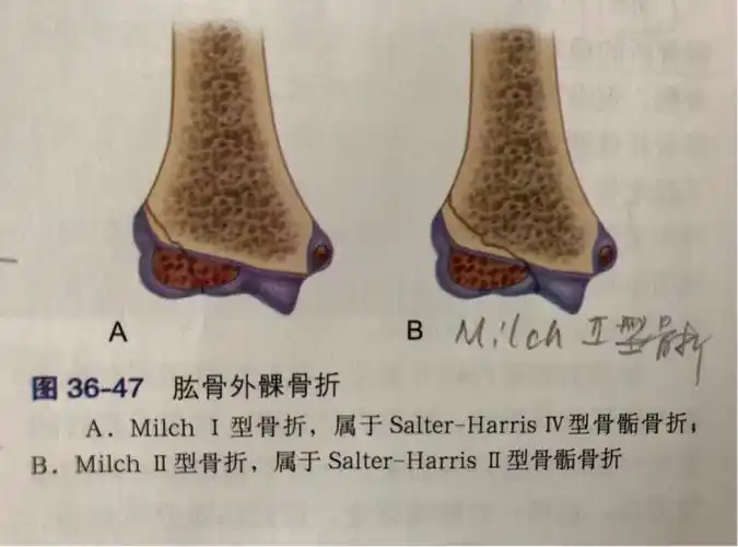 儿童肱骨外髁骨折,医生不说你很可能永远都不会知道的…… - 好大夫
