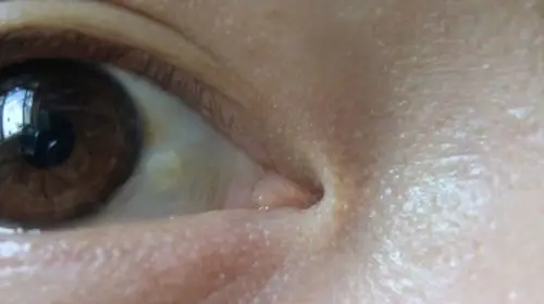 两只眼睛的白眼球都有黄色的东西是什么