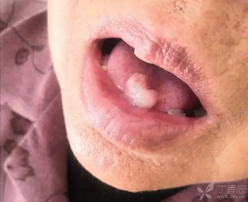 舌尖上长了一个肉疙瘩