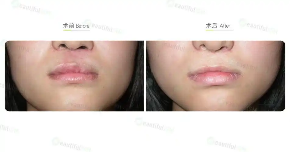 唇腭裂整形(女)效果图,案例前后对比照片