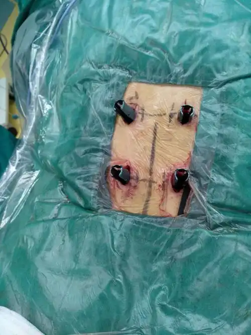 我院首例经皮椎弓根钉技术治疗胸腰段骨折 - 美篇