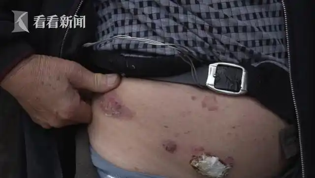 "78岁的龚兆元,身上的溃烂程度已经很严重,每天他都得换一张新的纸巾