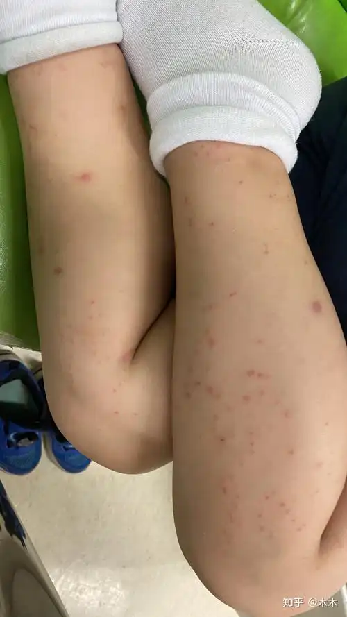 记录6岁孩子过敏性紫癜治疗过程