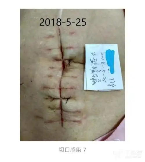 腹部切口分段感染,负压引流3天后缝合经验分享