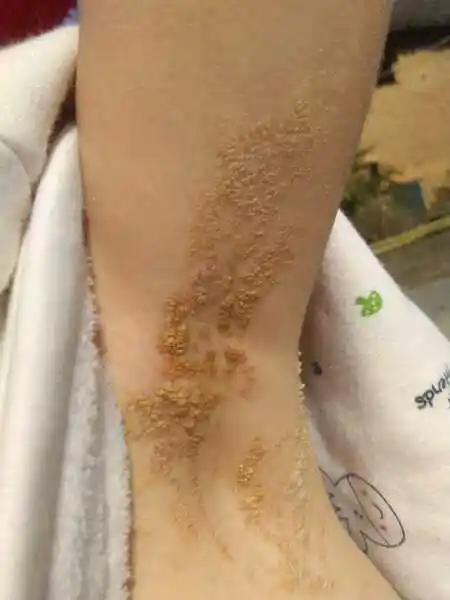 宝宝生下来两个多月的时候腋窝下就长了这个东西,不痛不痒的就没在意